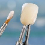 REASONS YOU MIGHT NEED A DENTAL CROWN